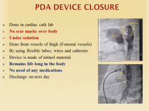 Treatment of Patent Ductus Arteriosus (PDA) | Best Heart Specialist in Lucknow